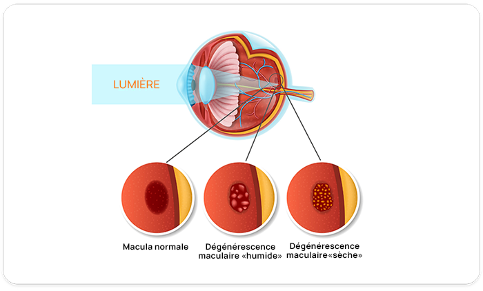 Macular Degeneration information